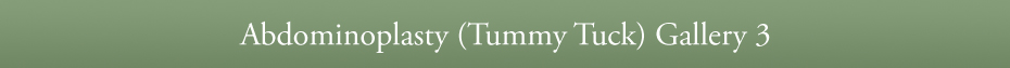 Abdominoplasty (Tummy Tuck) Gallery 3