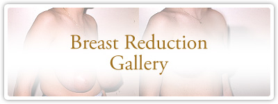 Breast Reduction Gallery