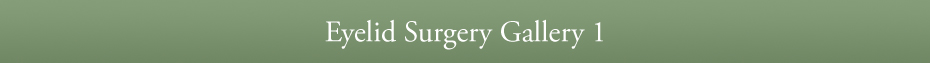 Eyelid Surgery Gallery 1