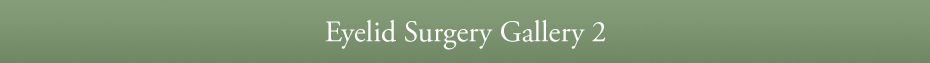 Eyelid Surgery Gallery 2