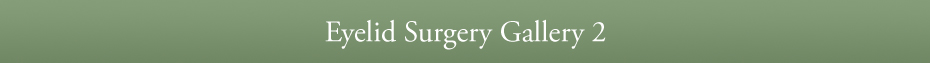 Eyelid Surgery Gallery 2