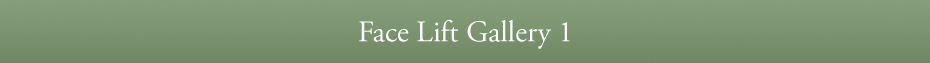 Face Lift Gallery 1