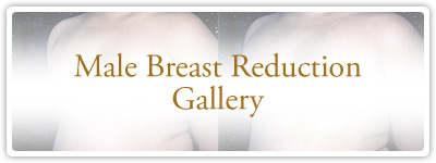 Male Breast Reduction Gallery