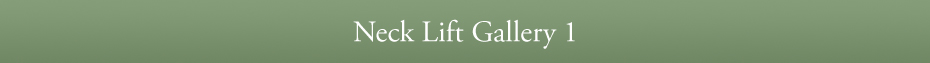 Neck Lift Gallery 1