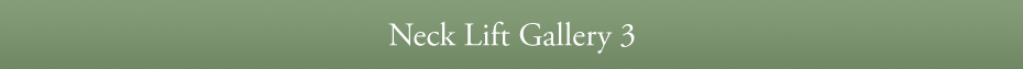 Neck Lift Gallery 3